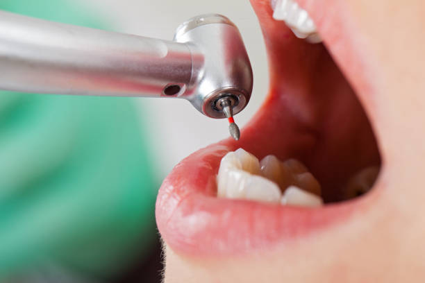Best Emergency Dental Care for Broken or Chipped Teeth in St Simons, GA